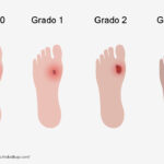 Piede diabetico: stadi