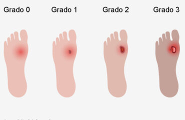 Piede diabetico: stadi