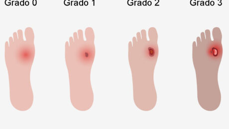 Piede diabetico: stadi