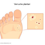 Verruche plantari