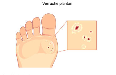 Verruche plantari