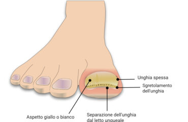 Unghia ispessita (onicogrifosi)