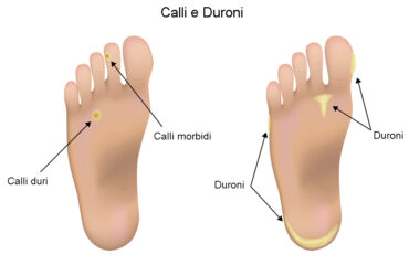 Calli e Duroni: la differenza