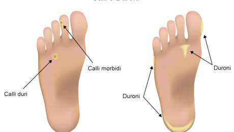 Calli e Duroni: la differenza